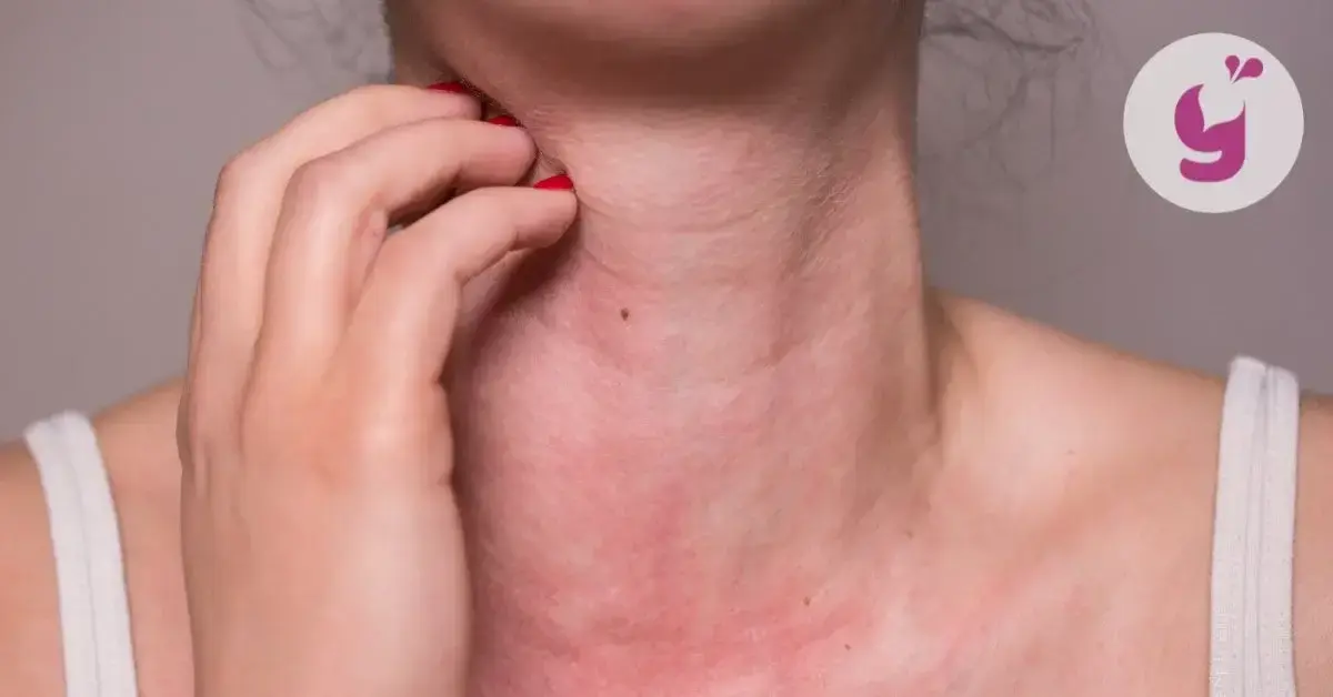 Alergia na slnko: vyrážka a iné prejavy, ktorá potrápia. Ako dlho trvá a čo je najlepšia prvá pomoc?