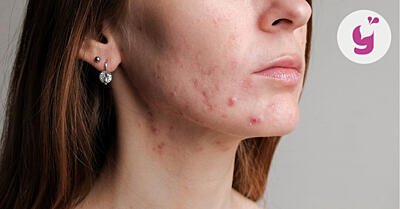 Hormonálne akné – vyrážky, ktoré trápia nielen tínedžerov